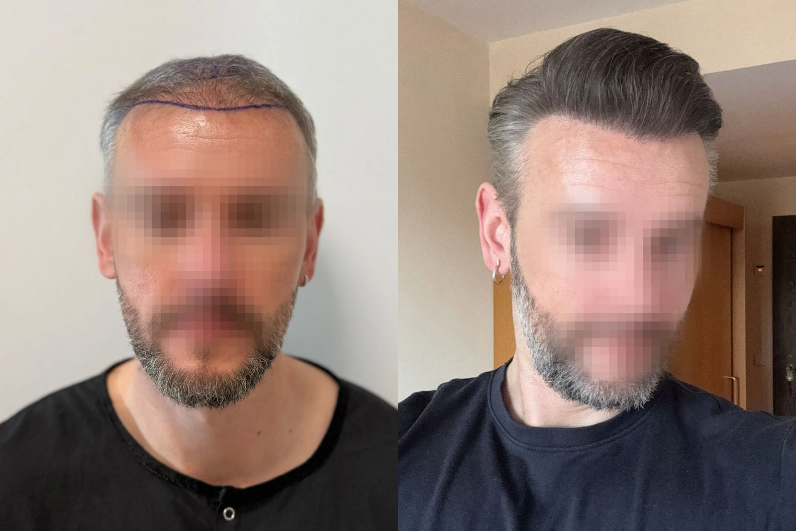 Before and 10-month result of a 3,078-graft FUE hair transplant placed among existing frontal and mid-scalp hair