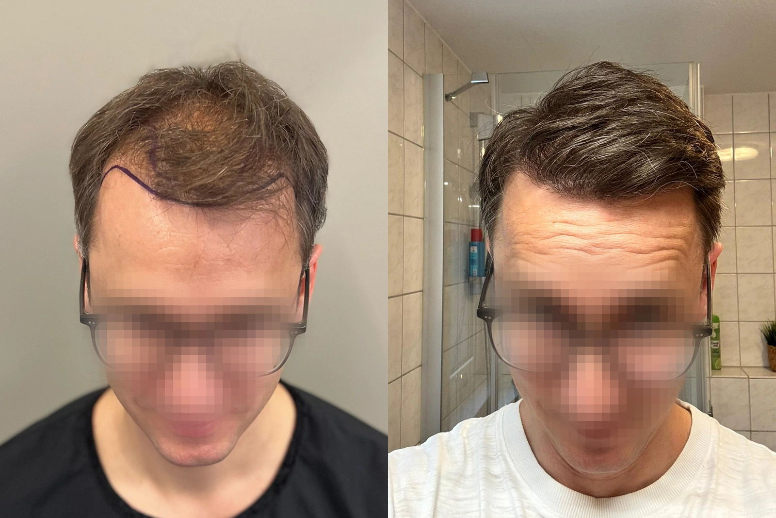 Before and 10-month result of a 3,248-graft FUE hair transplant with a soft frontal transition