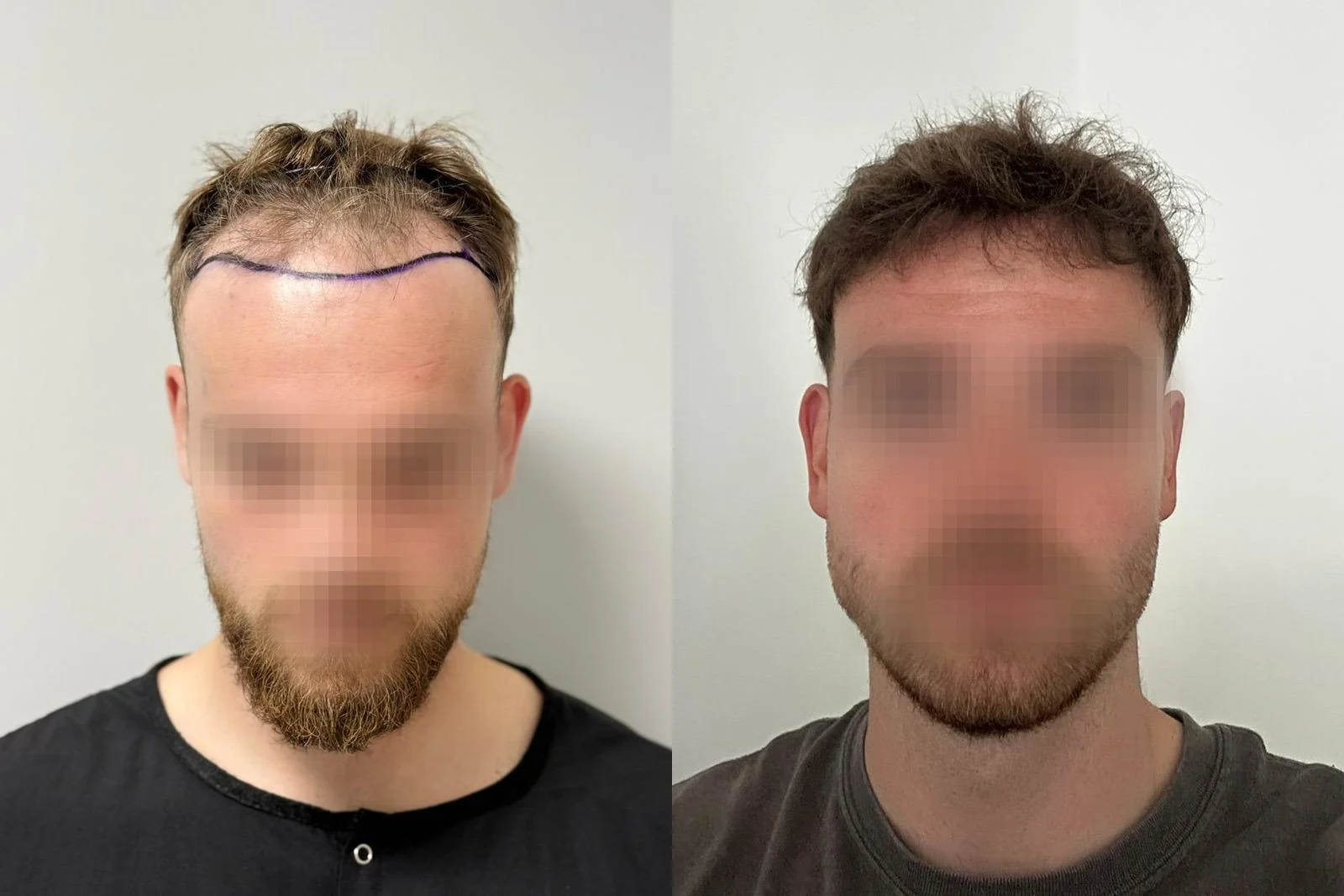 Before and 11-month result of a 3,596-graft FUE hair transplant focused on frontal hairline design
