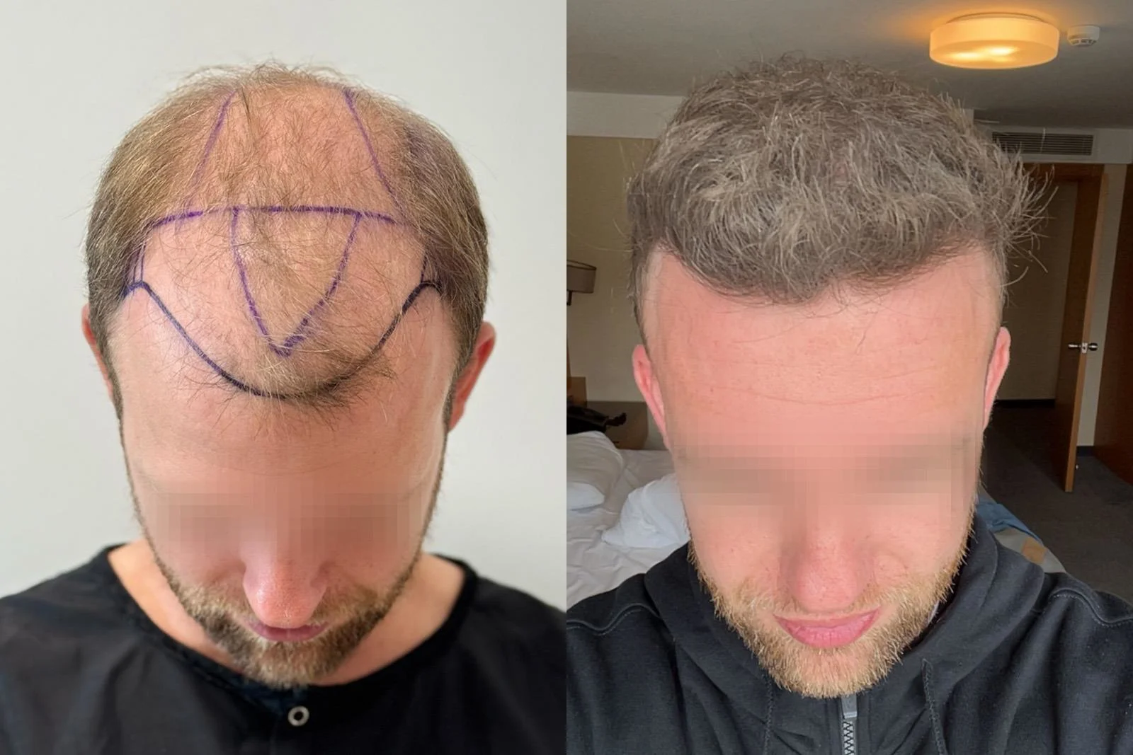 Before and 10-month result of a 3,612-graft FUE hair transplant with a second session deferred at follow-up