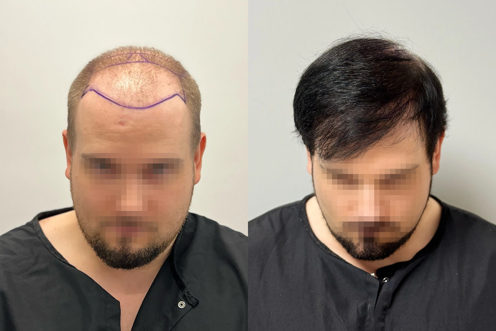 Before and 11-month result of a 3,802-graft FUE hair transplant containing at least 8,672 hairs