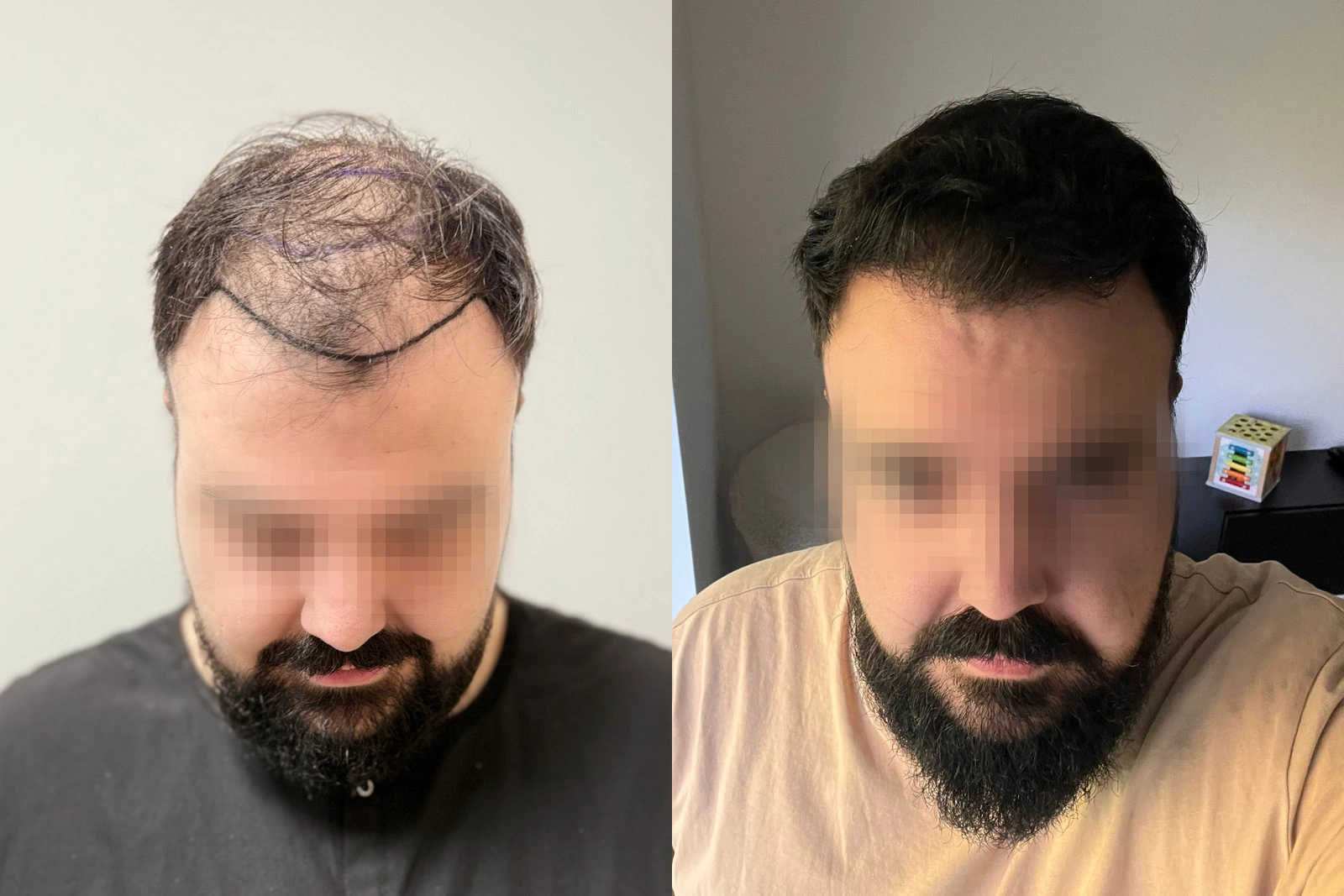 Before and 11-month result of a 3,804-graft FUE hair transplant for see-through frontal and mid-scalp thinning