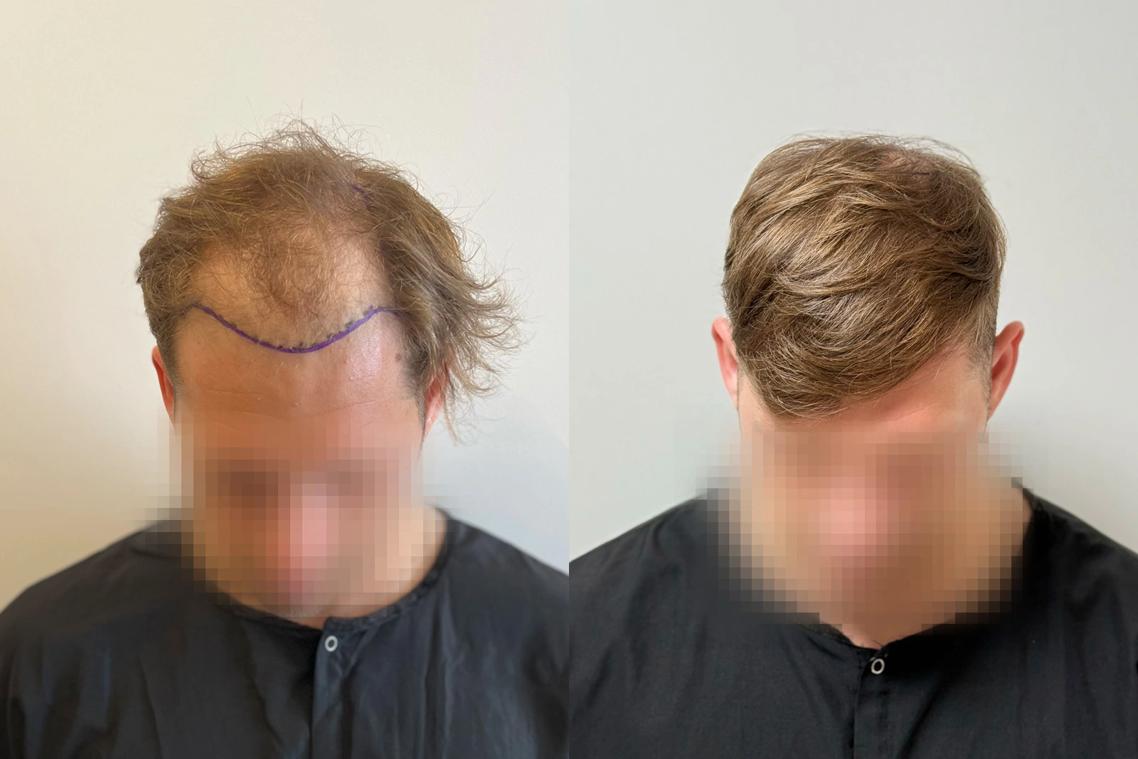 Before and 10-month result of a 3,849-graft FUE hair transplant in a patient already using minoxidil before surgery