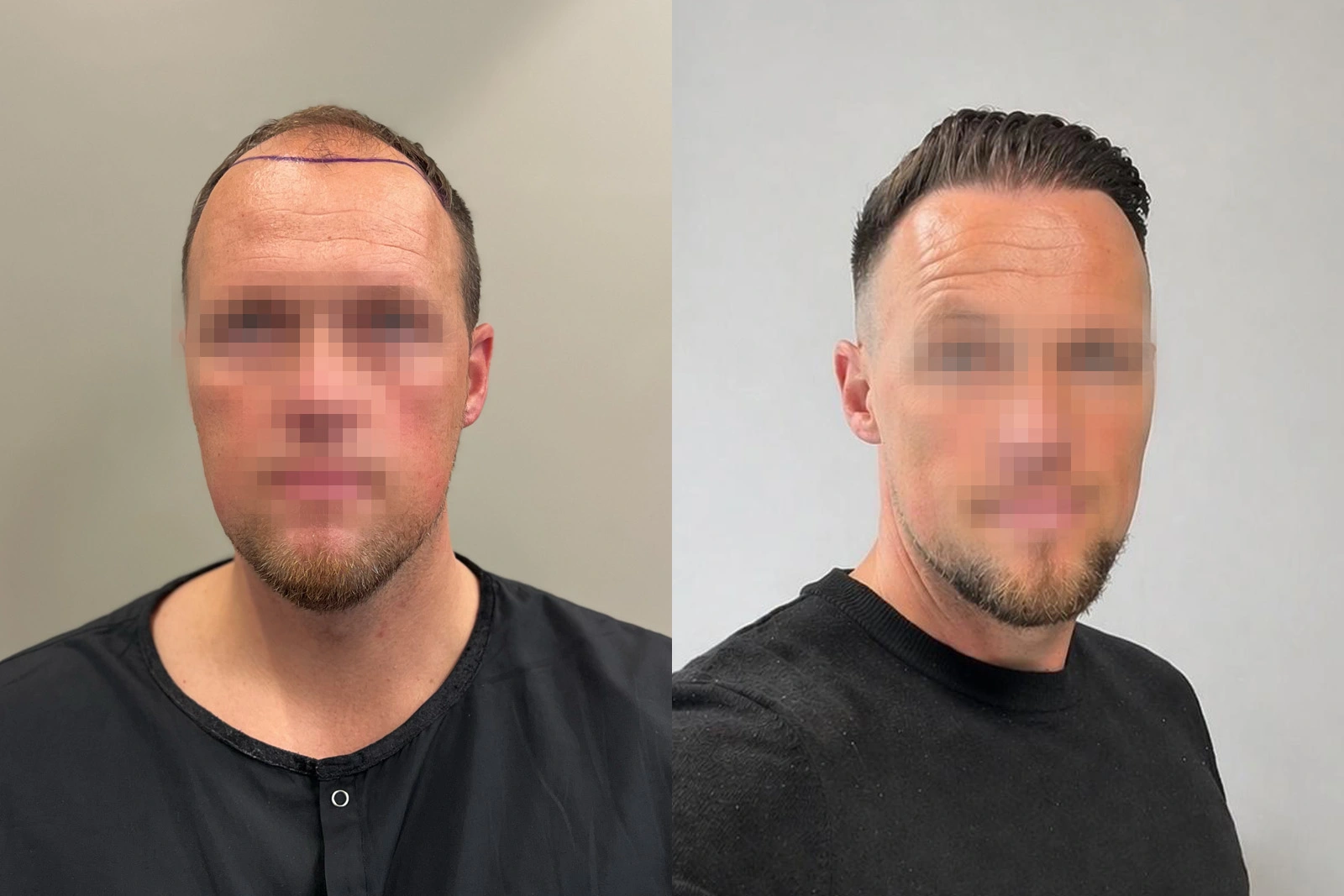 Before and 12-month result of a 3,853-graft FUE hair transplant to the frontal area and mid-scalp