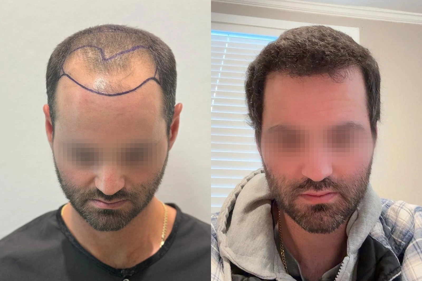 Before and 8-month result of a 4,065-graft FUE hair transplant focused on the frontal region and mid-scalp