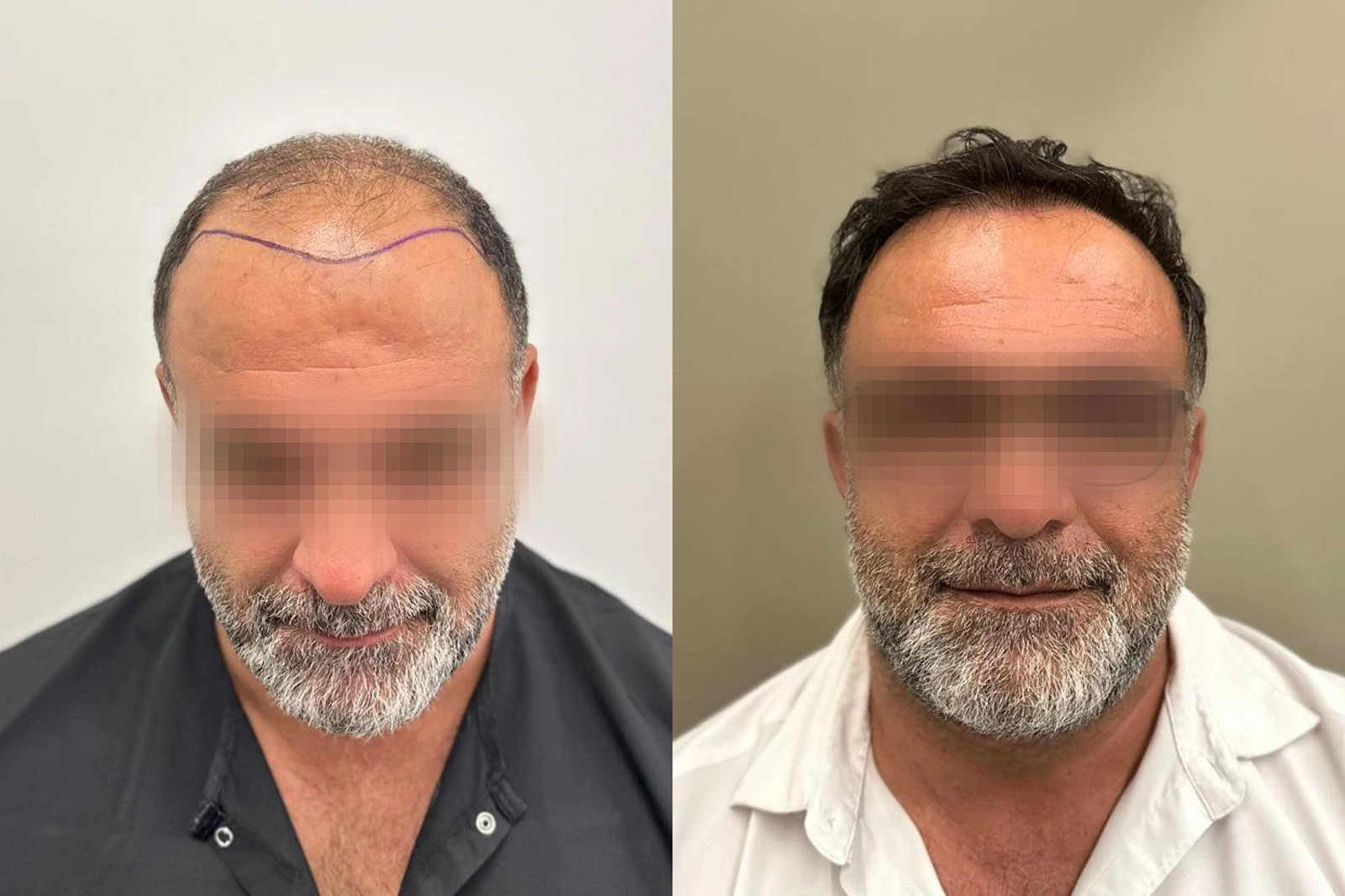Before and 8-month result of a 4,127-graft FUE hair transplant with mature hairline and mid-scalp restoration