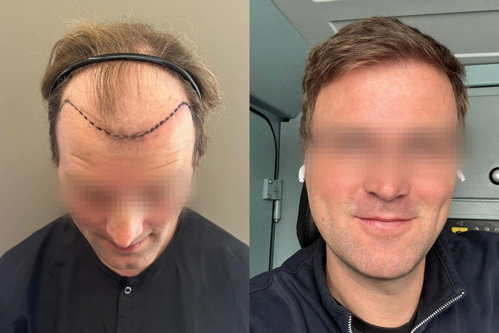 Before and 12-month result of a 4,450-graft FUE hair transplant containing 9,201 transplanted hairs