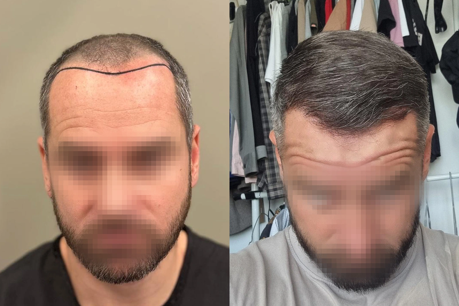 Before and 10-month result of a 4,610-graft FUE hair transplant focused on the frontal area and mid-scalp