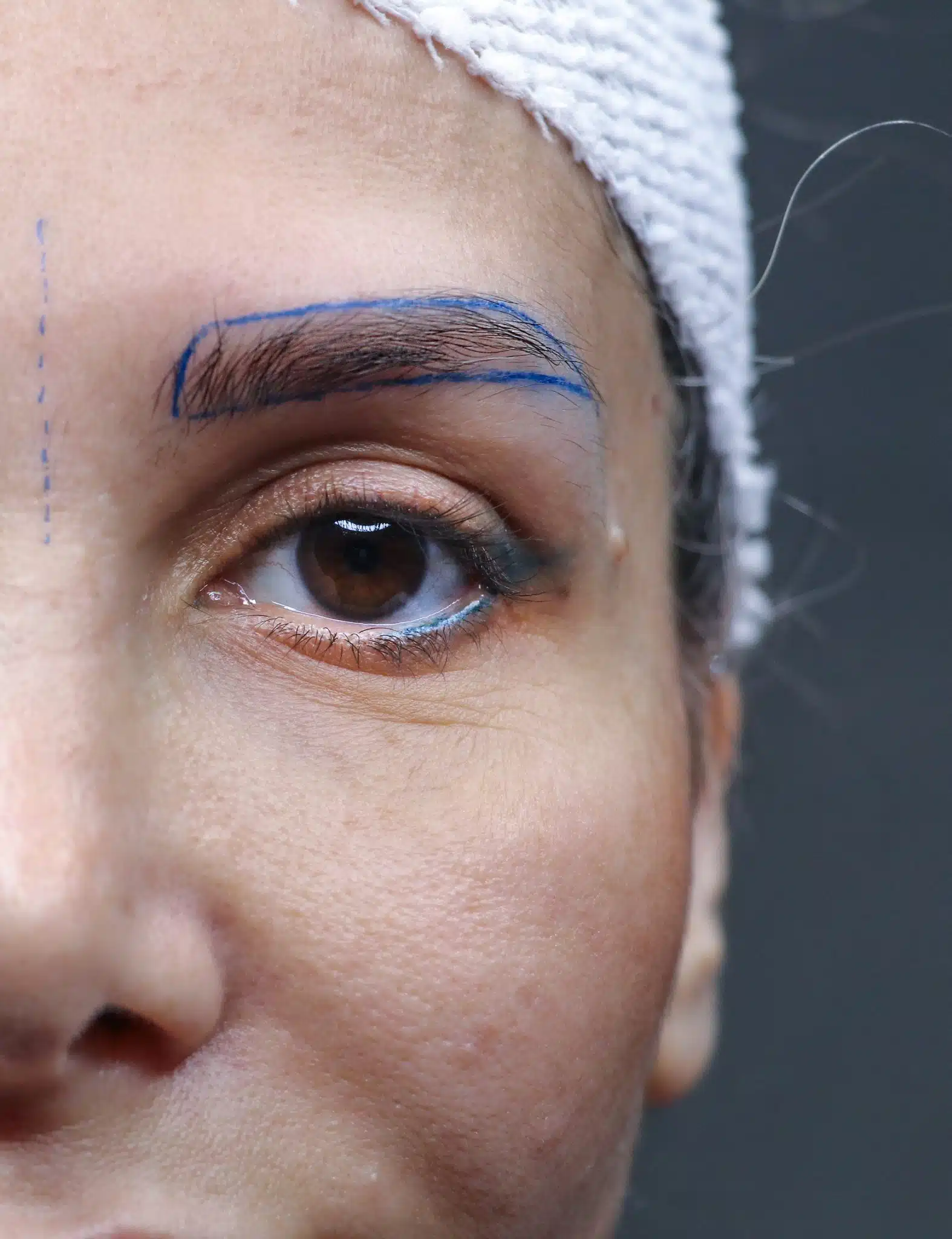 Eyebrow transplantation at Pure Line Clinic Istanbul