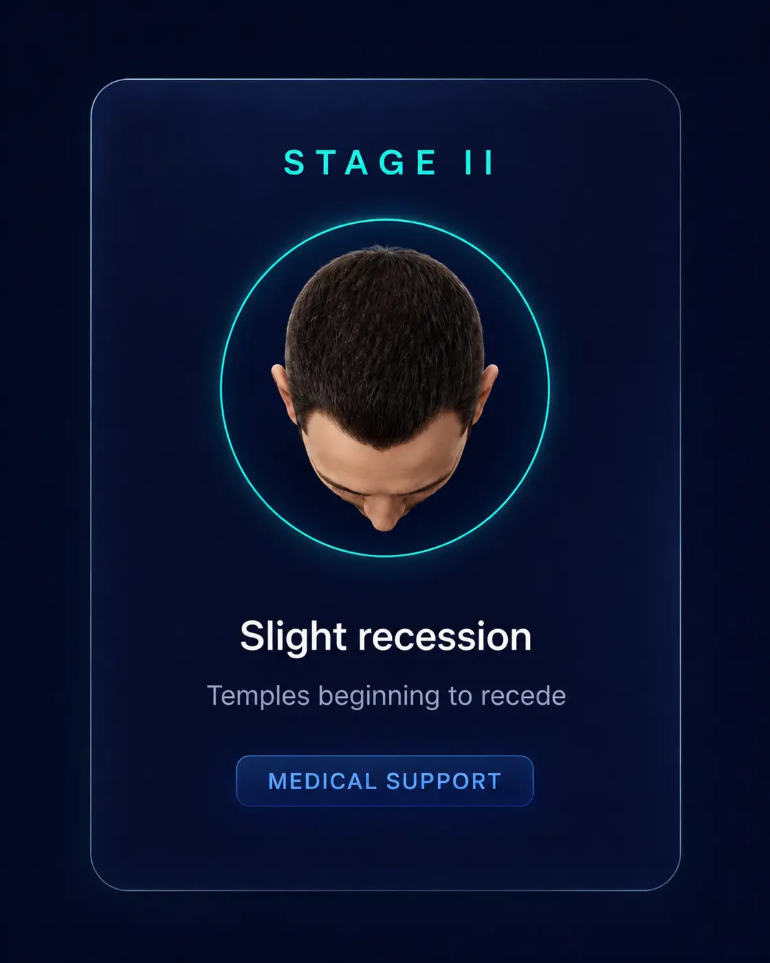 Norwood Stage II — Slight recession, Medical Support