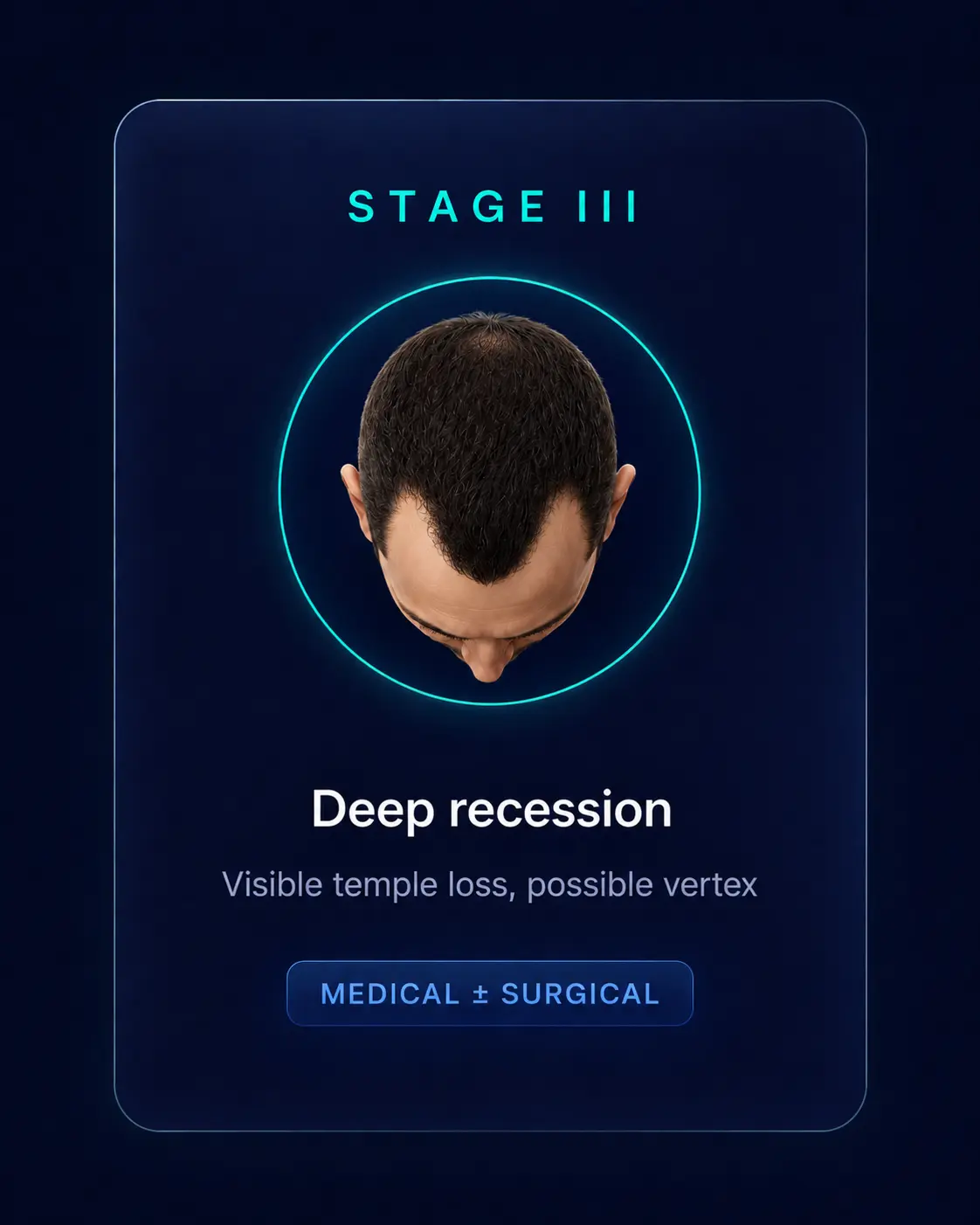 Norwood Stage III — Deep recession, Medical ± Surgical