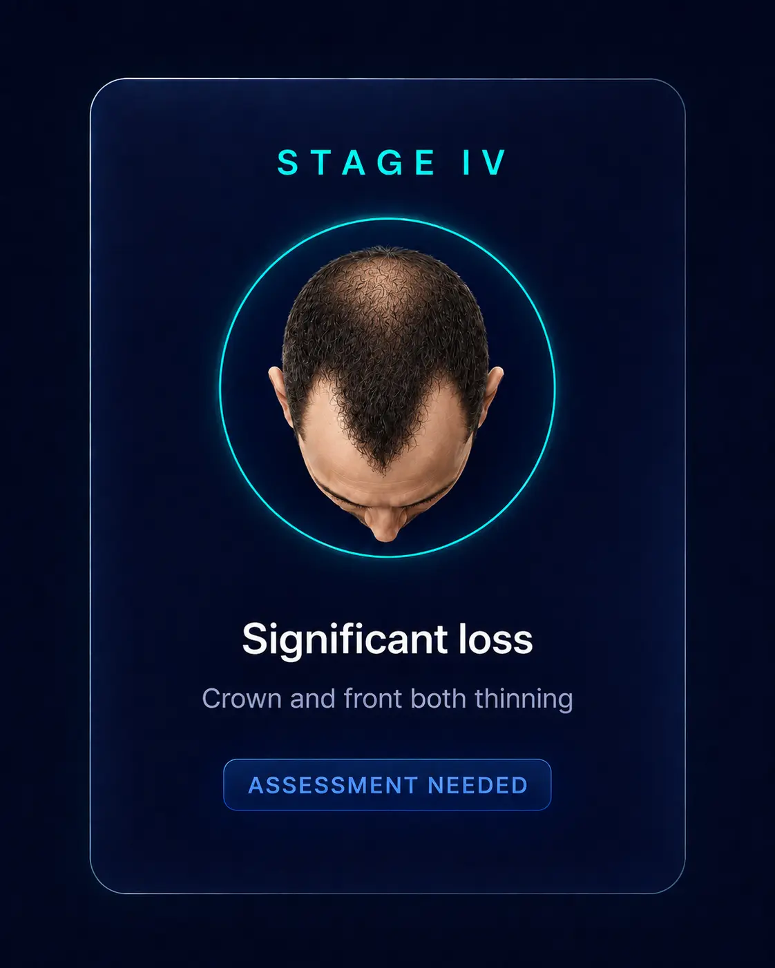 Norwood Stage IV — Significant loss, Assessment Needed