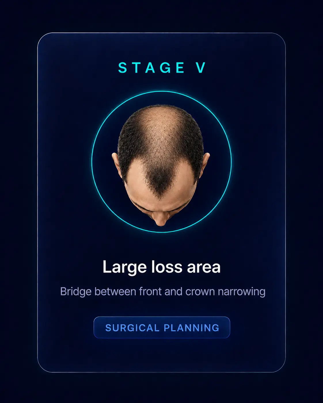 Norwood Stage V — Large loss area, Surgical Planning