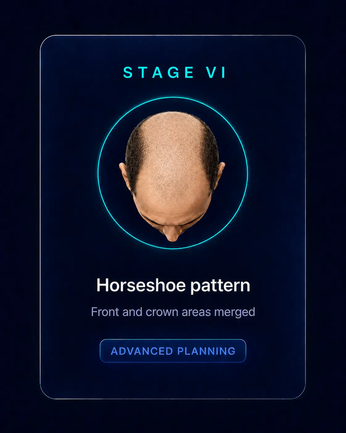 Norwood Stage VI — Horseshoe pattern, Advanced Planning