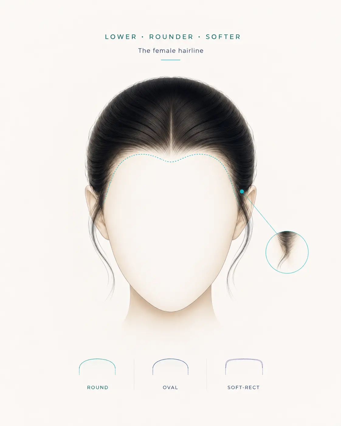 Female hairline design — lower, rounder, softer