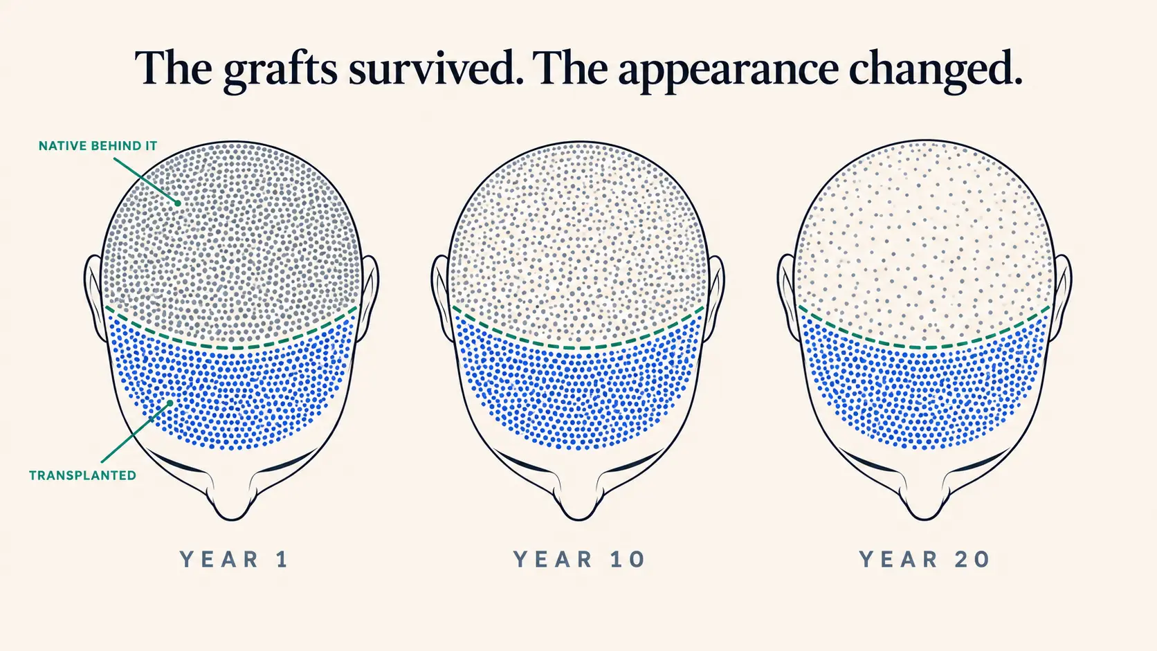 Three top-down scalp diagrams at year 1, year 10 and year 20 after a hair transplant, with hair shown as dot density. The transplanted zone behind the hairline keeps almost the same density in all three panels, while the native hair behind the boundary line thins from dense at year 1 to sparse at year 20, showing that transplanted grafts can survive while the overall appearance still changes