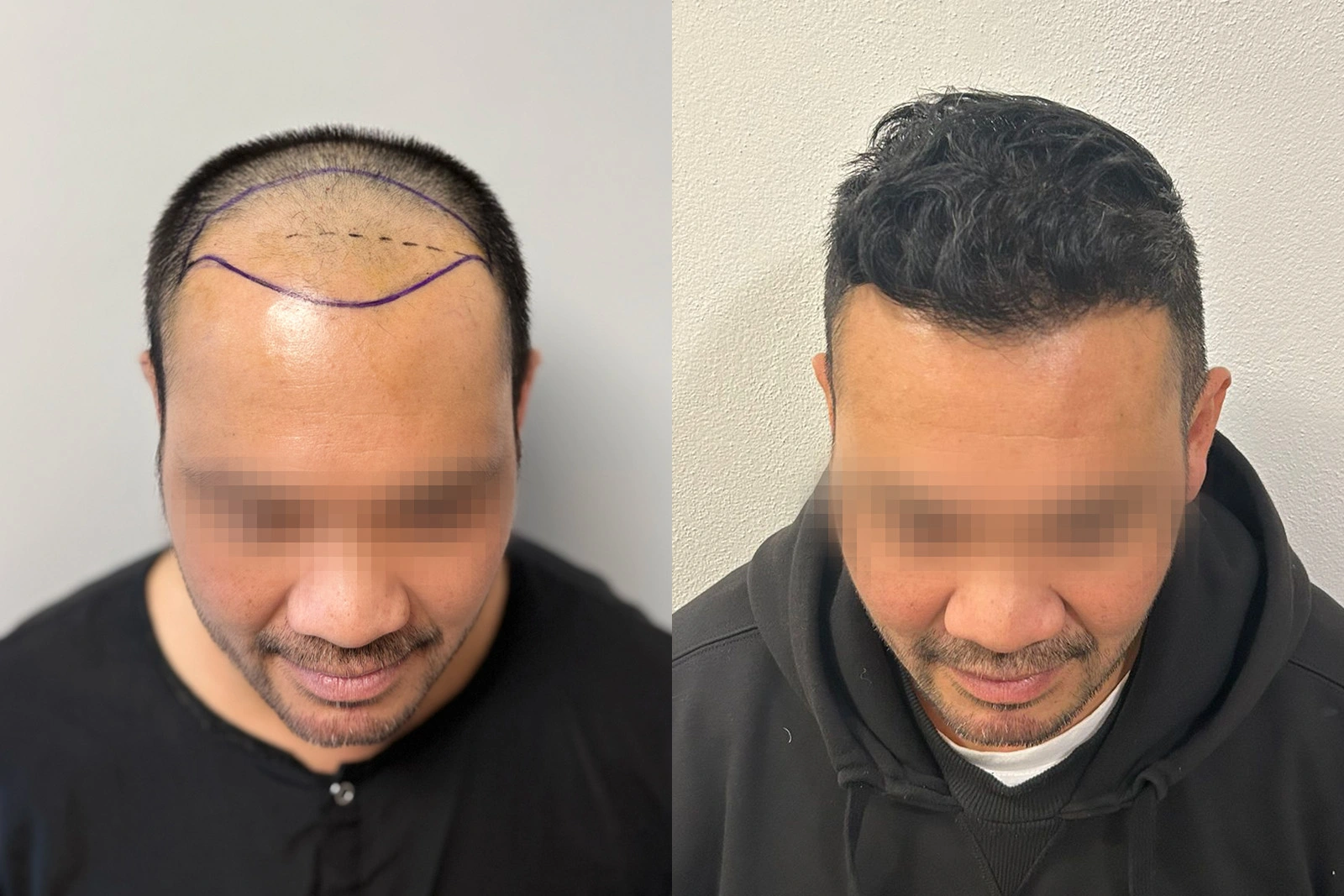 Hair transplant before & after — 3,720 grafts at 10 months