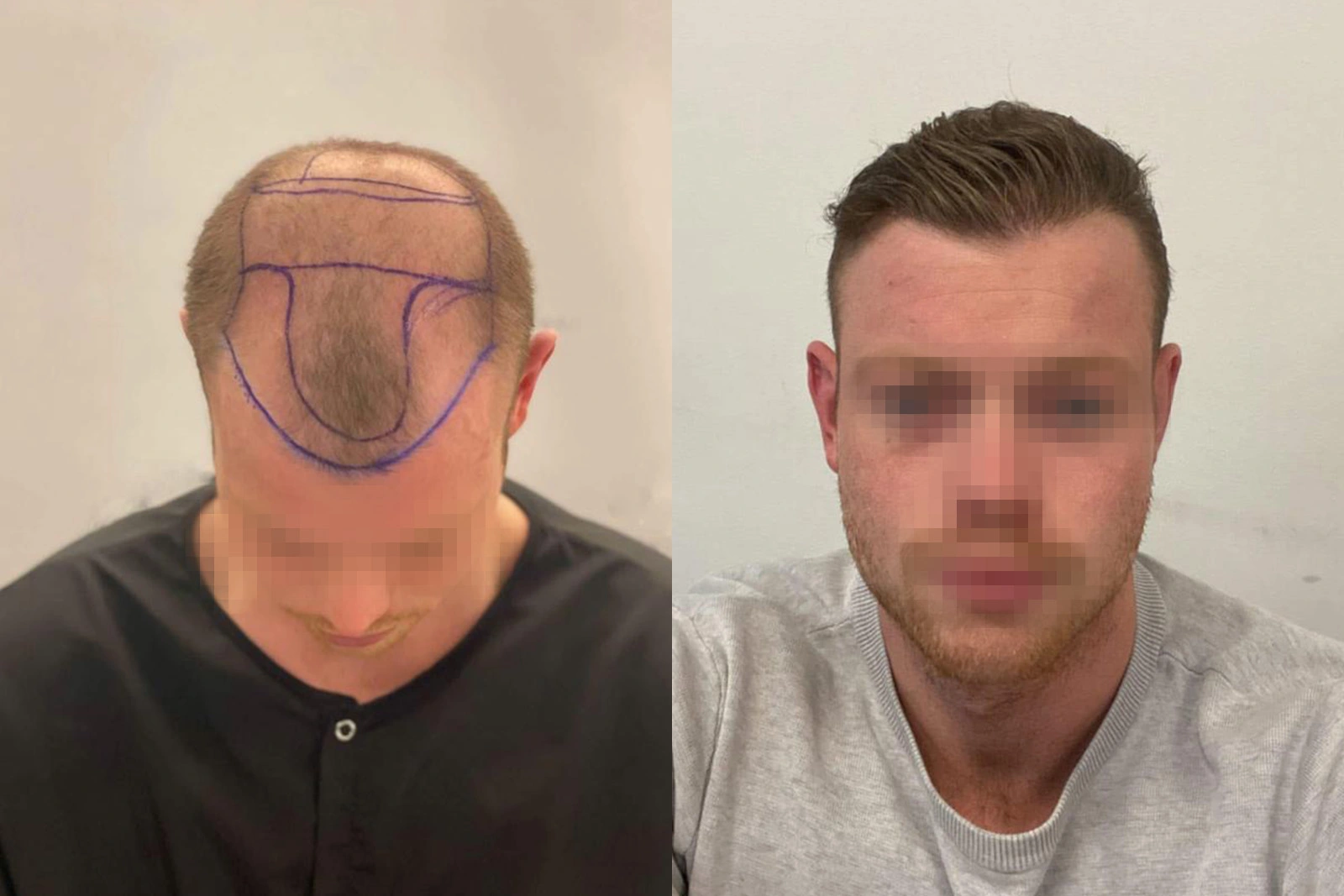 Hair transplant before & after — 4,532 grafts at 8 months