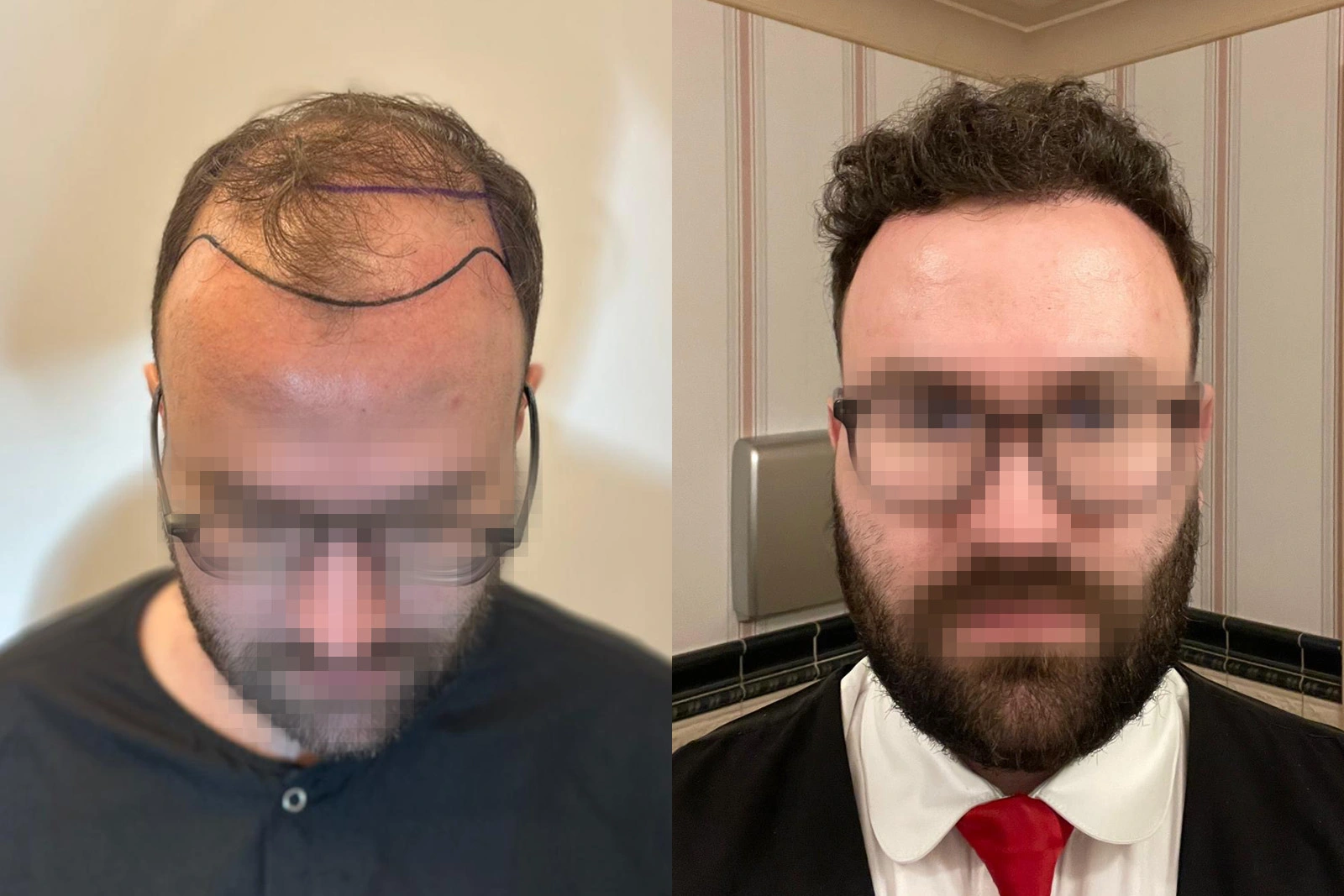 Hair transplant before & after — 4,635 grafts at 12 months