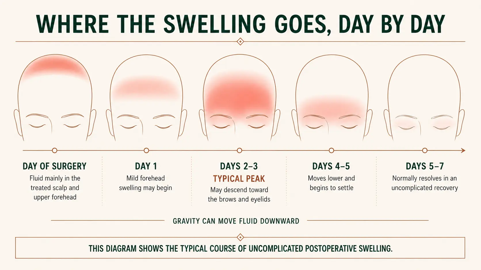 Five-stage diagram of forehead swelling after a hair transplant: fluid in the treated scalp on the day of surgery, mild forehead swelling on day one, a typical peak on days two to three that may descend toward the brows and eyelids, settling on days four to five, and normal resolution by days five to seven
