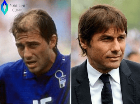 Antonio Conte Before & After Hair Transplant