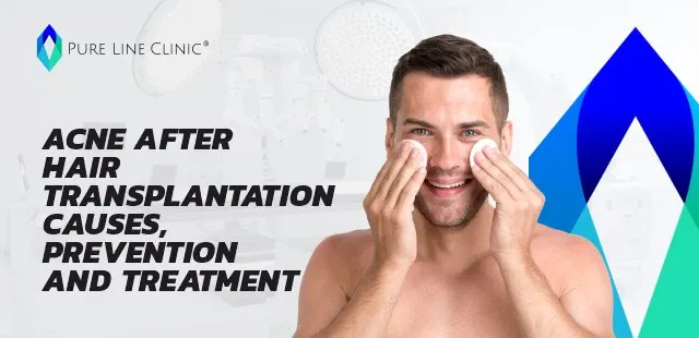 Acne After Hair Tranplantation Causes,Prevention and Treatment