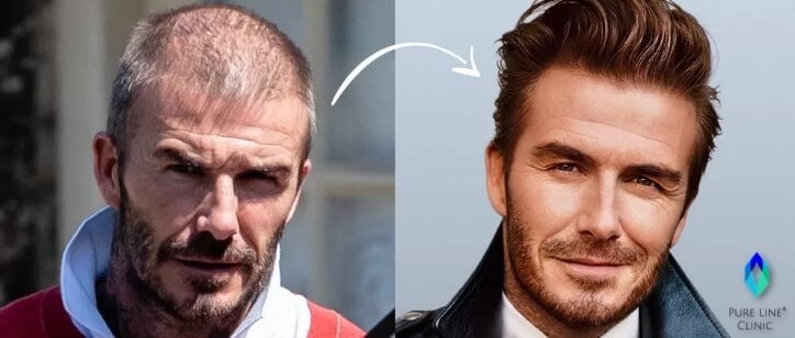 David Beckham Before and After Hair Transplant