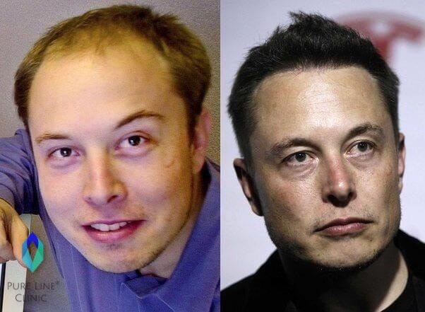 Elon Musk Hair Transplant Before After