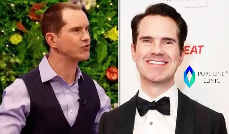 Jimmy Carr Hair Transplant Before And After 