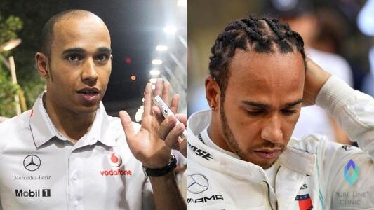 Louis Hamilton Before After Hair Transplant