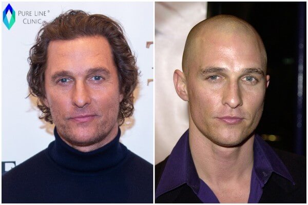 Matthew McConaughey Hair Transplant Before And After