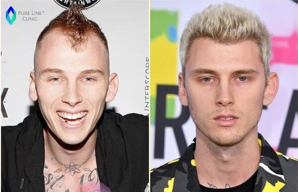 MGK Hair Transplant Before and After