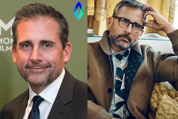 Steve Carell Hair Transplant Before After