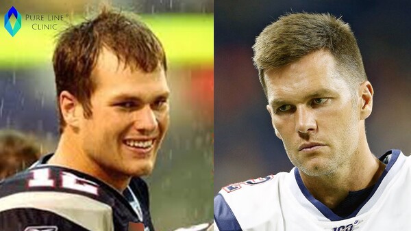 Tom Brady Hair Transplant Before and After