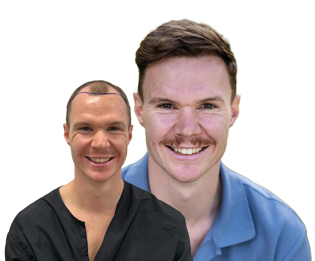 Pure Line Clinic Hair Transplant Result